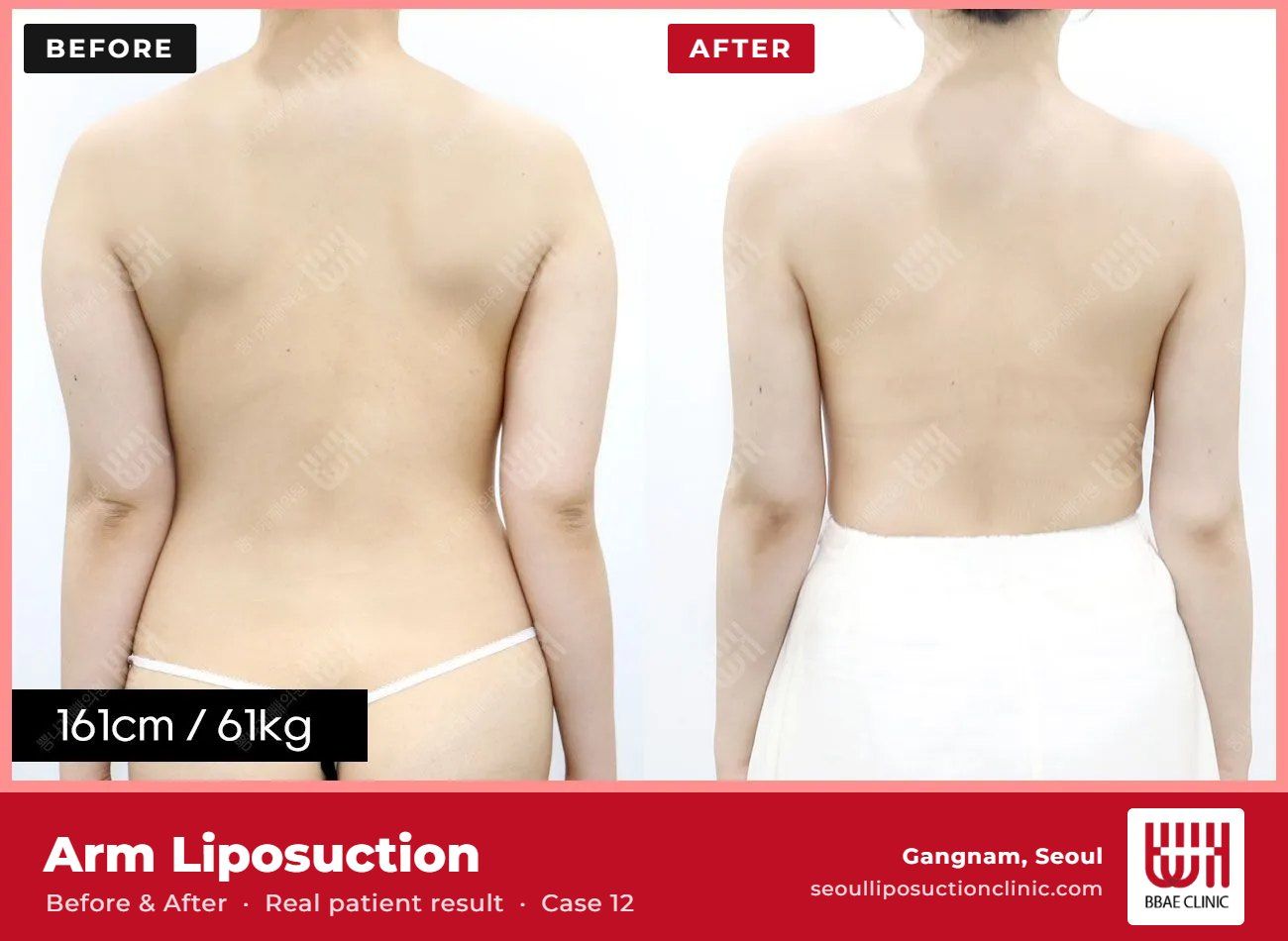 Arm liposuction before and after, case 12 (photo 2 of 2) – BBAE Clinic, Gangnam Seoul