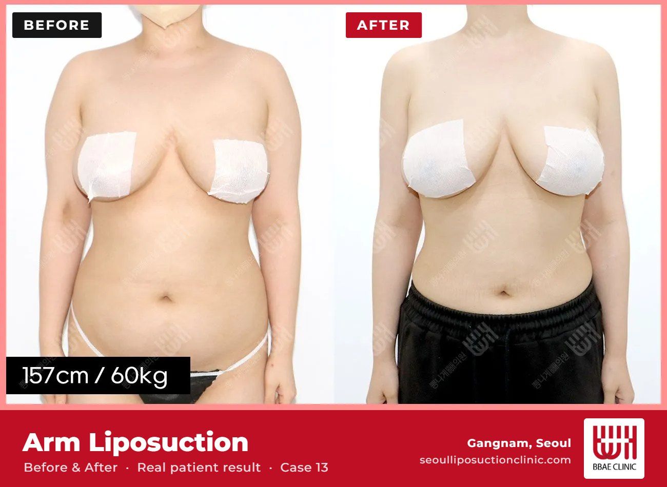 Arm liposuction before and after, case 13 (photo 1 of 2) – BBAE Clinic, Gangnam Seoul