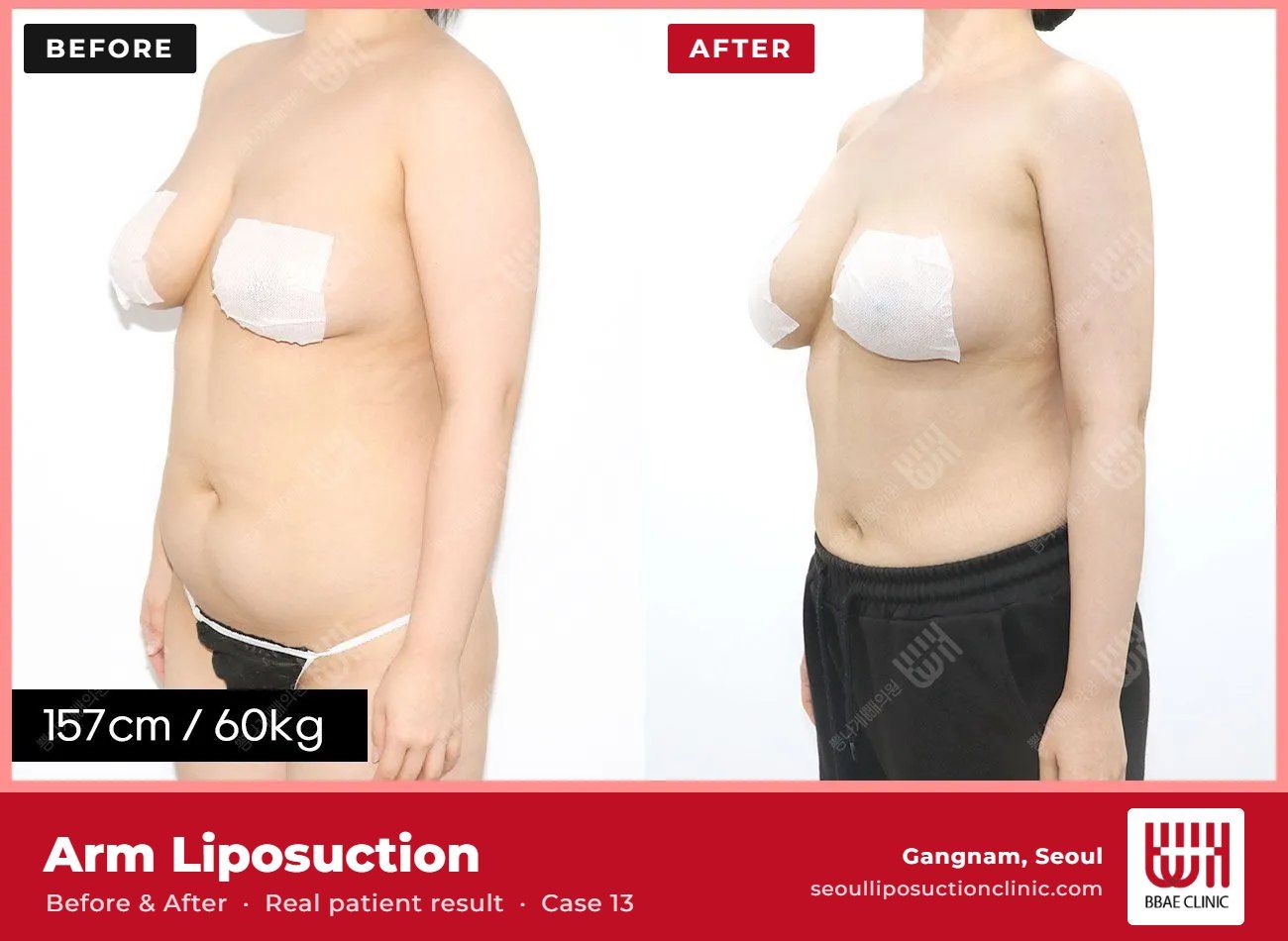 Arm liposuction before and after, case 13 (photo 2 of 2) – BBAE Clinic, Gangnam Seoul