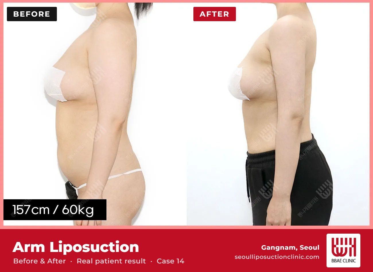 Arm liposuction before and after, case 14 (photo 1 of 2) – BBAE Clinic, Gangnam Seoul
