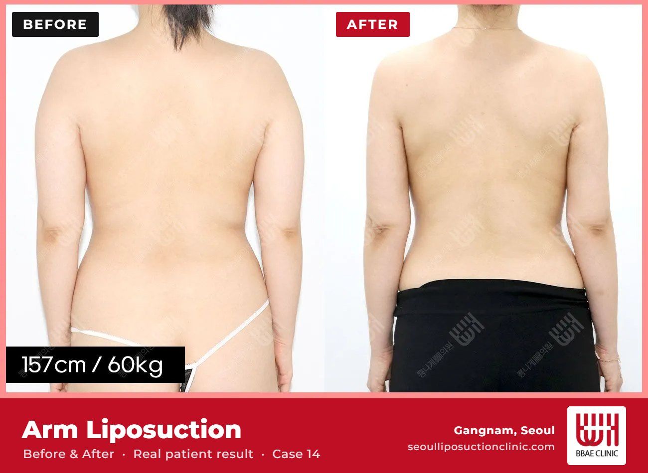 Arm liposuction before and after, case 14 (photo 2 of 2) – BBAE Clinic, Gangnam Seoul