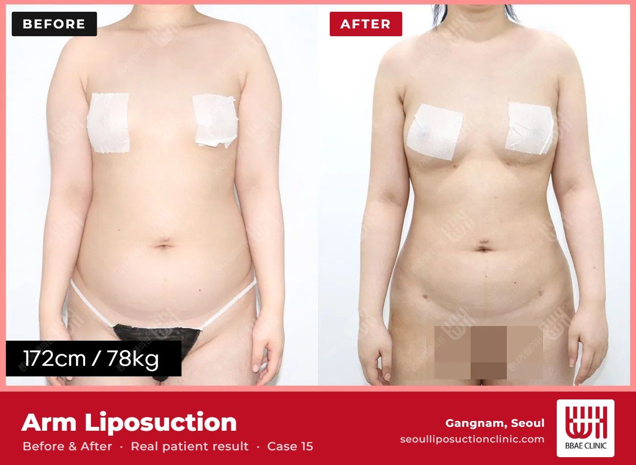 Arm liposuction before and after, case 15 (photo 1 of 2) – BBAE Clinic, Gangnam Seoul