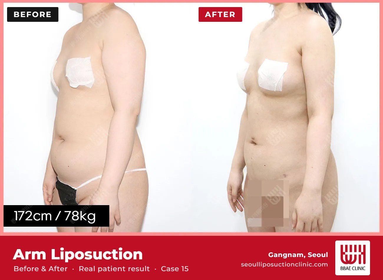 Arm liposuction before and after, case 15 (photo 2 of 2) – BBAE Clinic, Gangnam Seoul