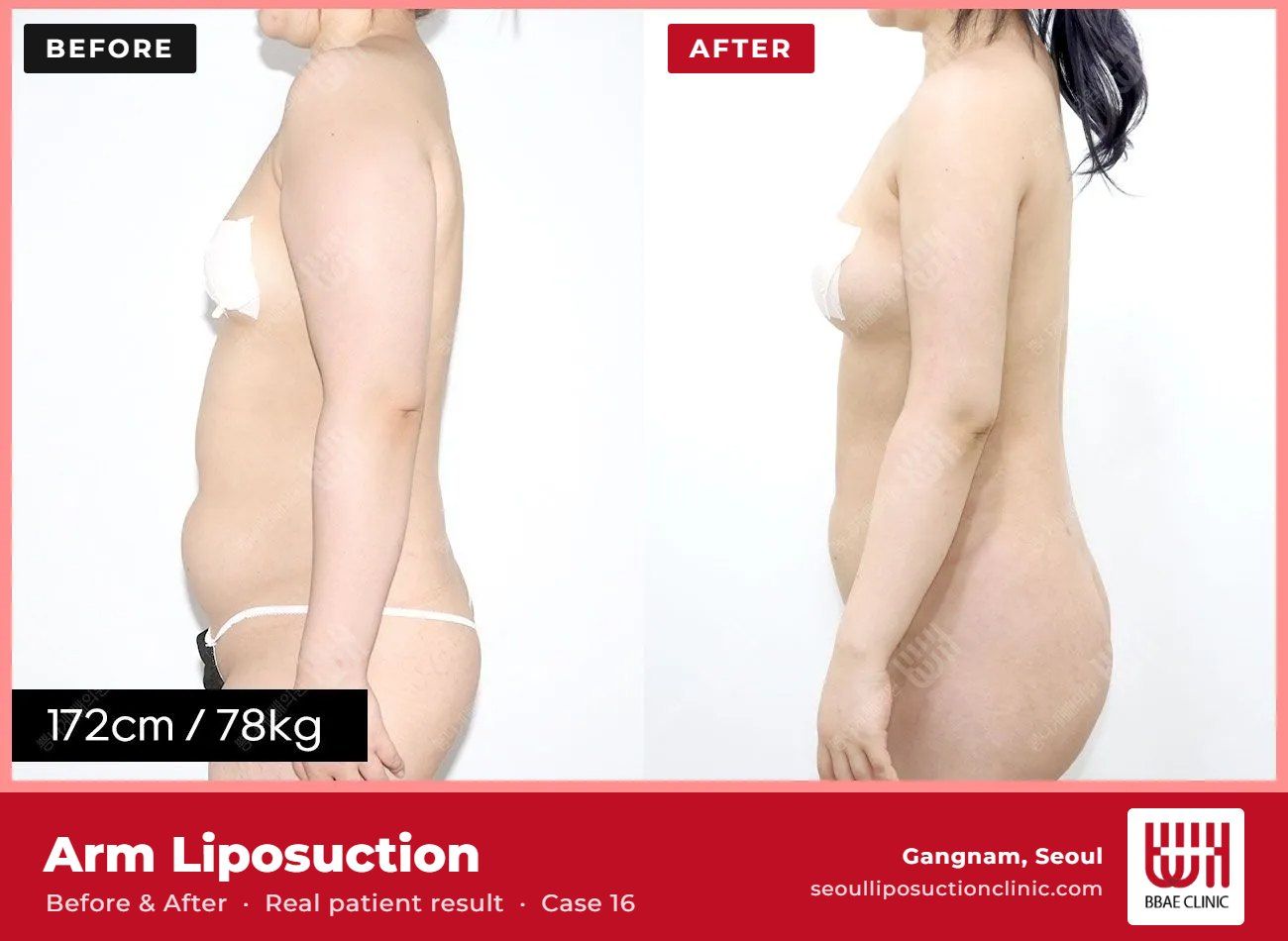 Arm liposuction before and after, case 16 (photo 1 of 2) – BBAE Clinic, Gangnam Seoul