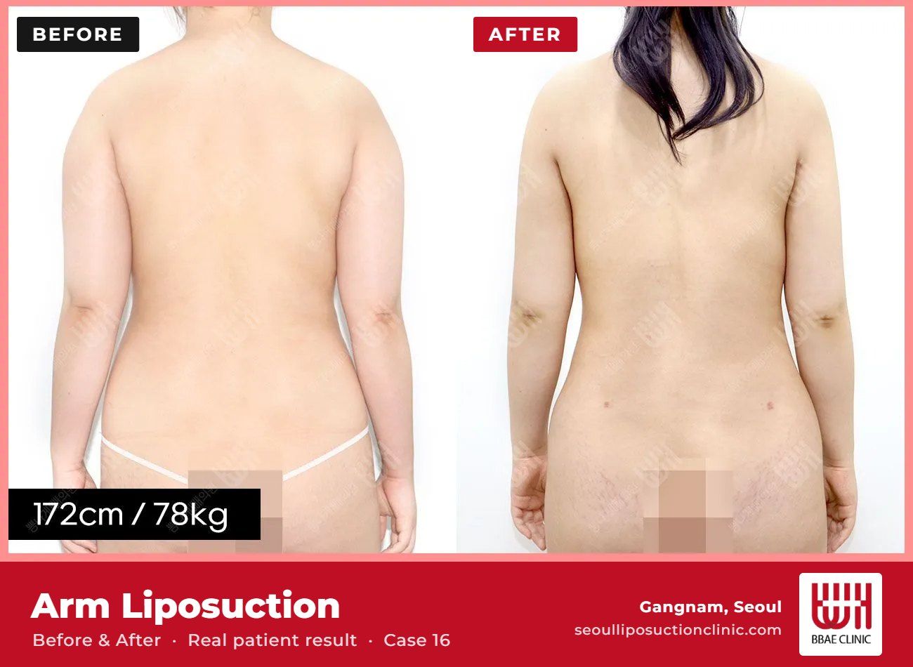 Arm liposuction before and after, case 16 (photo 2 of 2) – BBAE Clinic, Gangnam Seoul