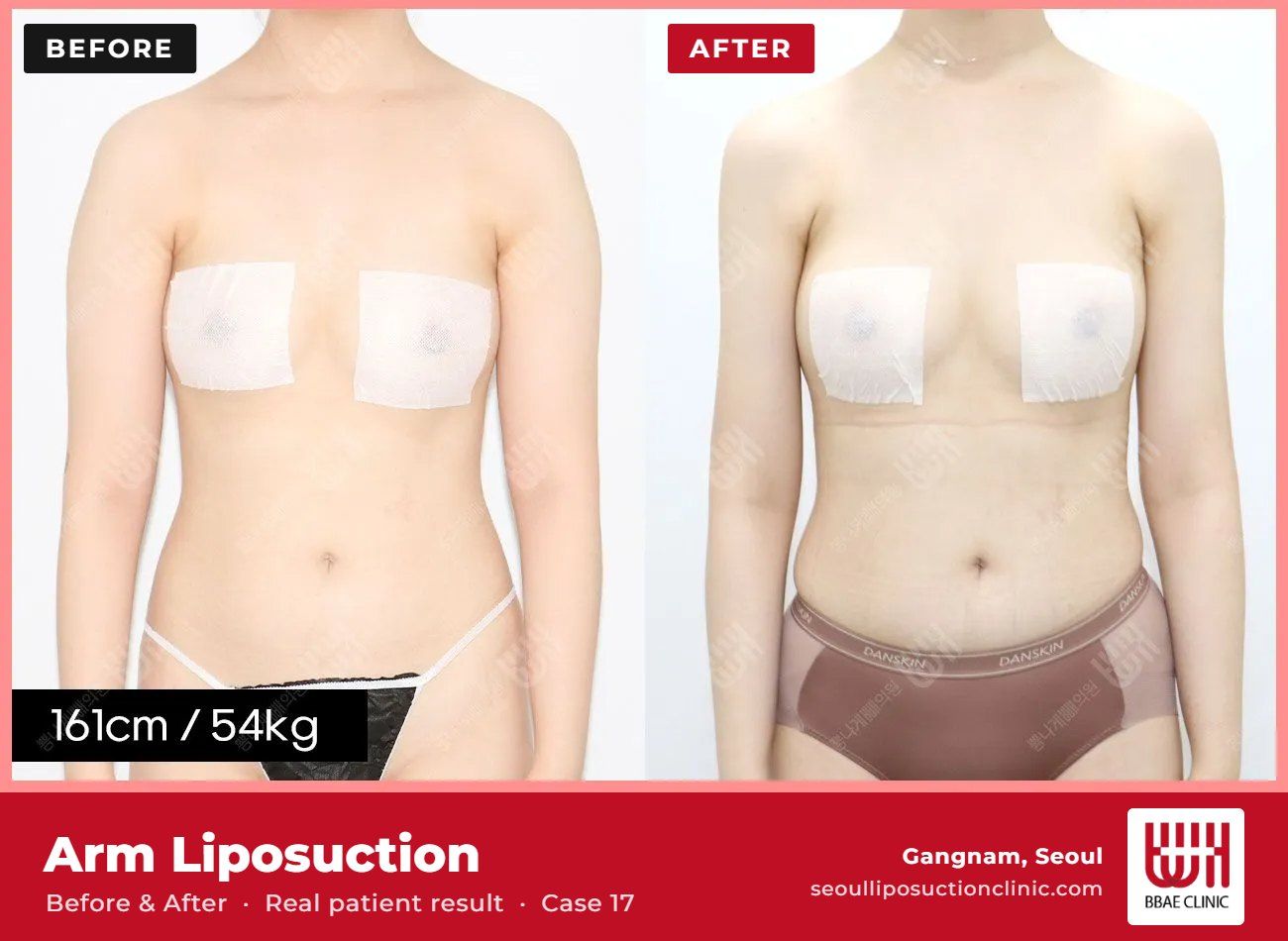 Arm liposuction before and after, case 17 (photo 1 of 2) – BBAE Clinic, Gangnam Seoul