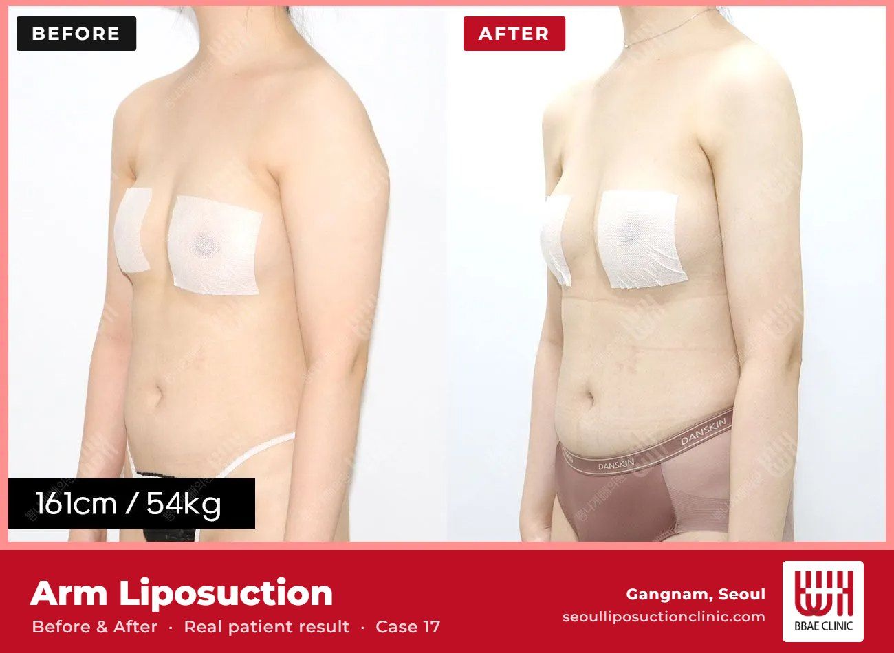 Arm liposuction before and after, case 17 (photo 2 of 2) – BBAE Clinic, Gangnam Seoul