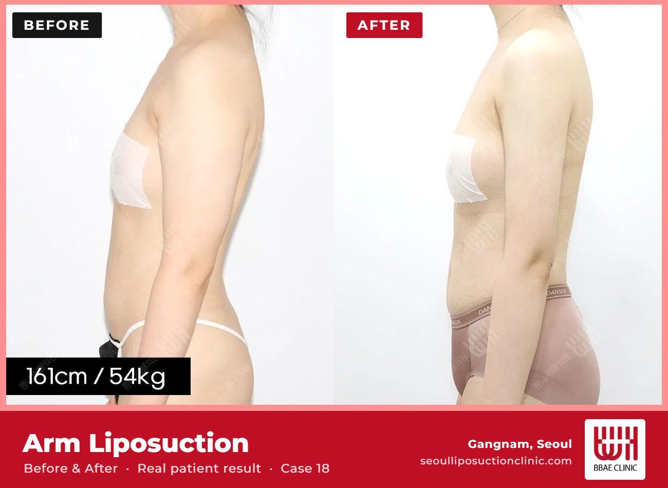 Arm liposuction before and after, case 18 (photo 1 of 2) – BBAE Clinic, Gangnam Seoul