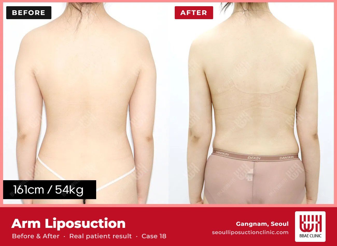 Arm liposuction before and after, case 18 (photo 2 of 2) – BBAE Clinic, Gangnam Seoul