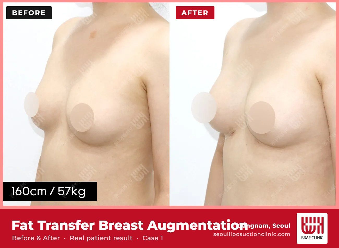 Fat transfer breast augmentation before and after, case 1 (photo 1 of 2) – BBAE Clinic, Gangnam Seoul