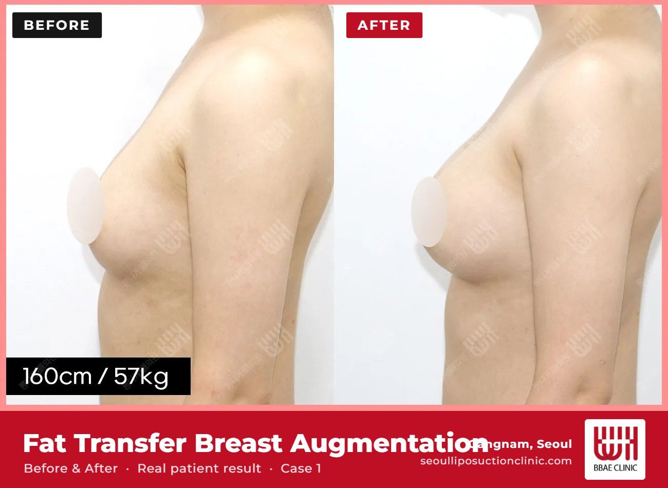 Fat transfer breast augmentation before and after, case 1 (photo 2 of 2) – BBAE Clinic, Gangnam Seoul