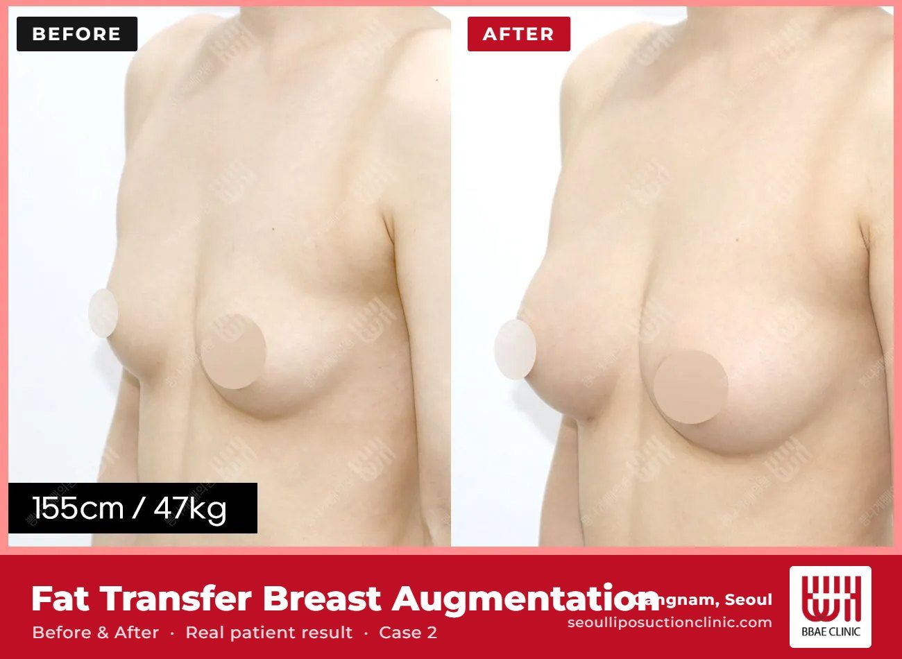 Fat transfer breast augmentation before and after, case 2 (photo 1 of 2) – BBAE Clinic, Gangnam Seoul