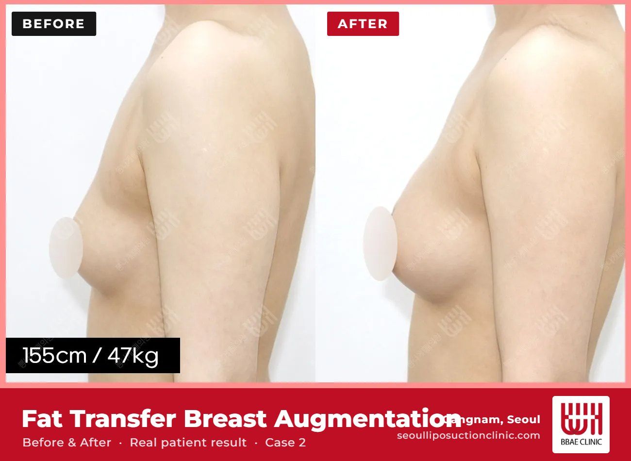 Fat transfer breast augmentation before and after, case 2 (photo 2 of 2) – BBAE Clinic, Gangnam Seoul