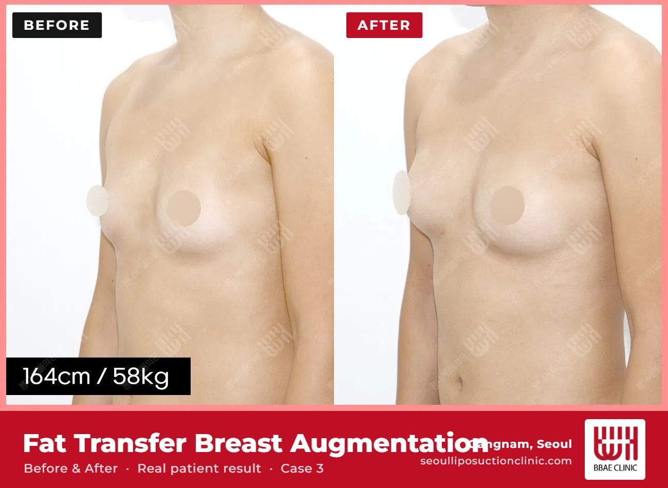 Fat transfer breast augmentation before and after, case 3 (photo 1 of 2) – BBAE Clinic, Gangnam Seoul