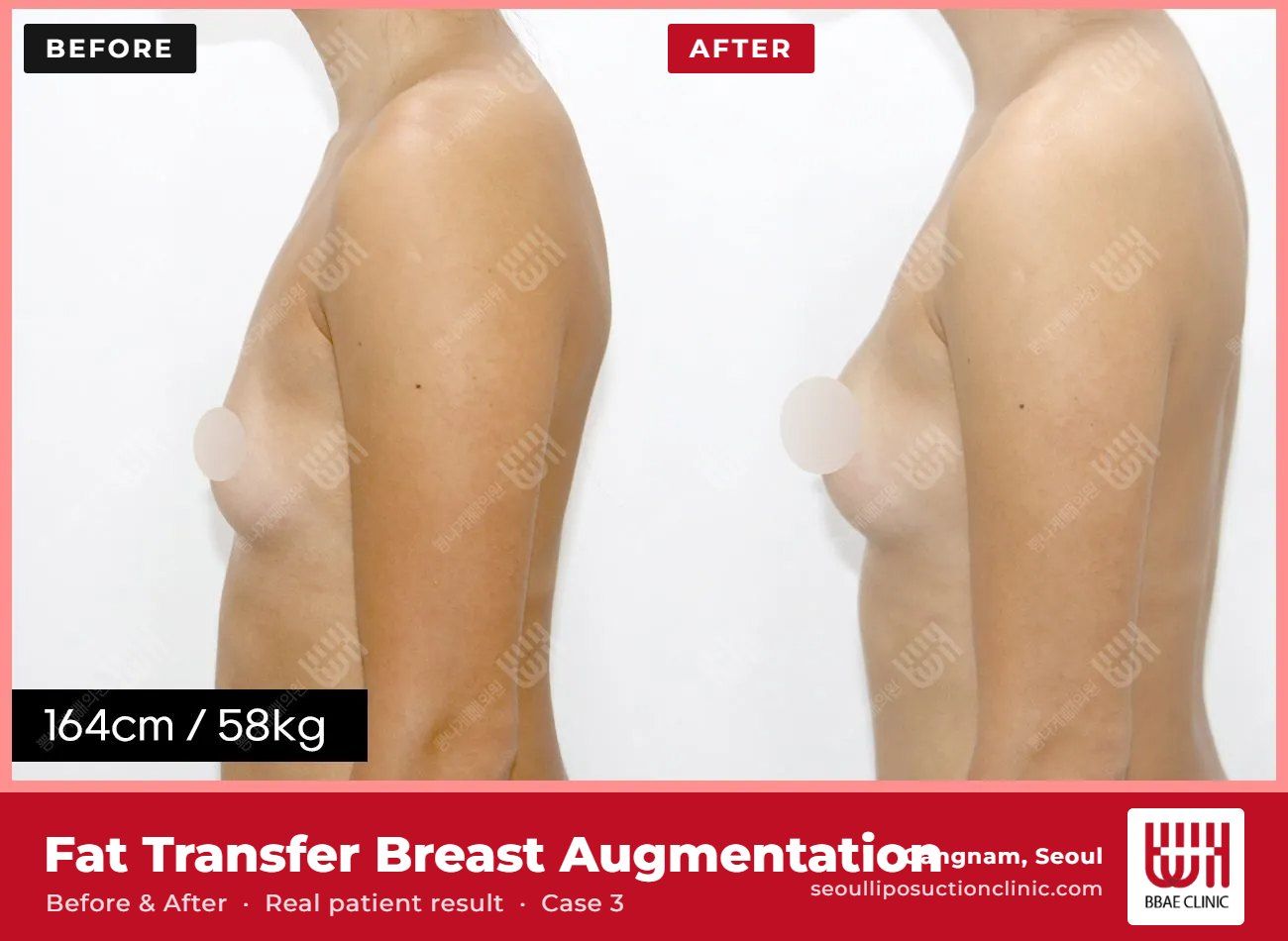 Fat transfer breast augmentation before and after, case 3 (photo 2 of 2) – BBAE Clinic, Gangnam Seoul