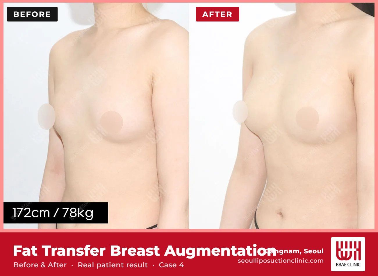 Fat transfer breast augmentation before and after, case 4 (photo 1 of 2) – BBAE Clinic, Gangnam Seoul