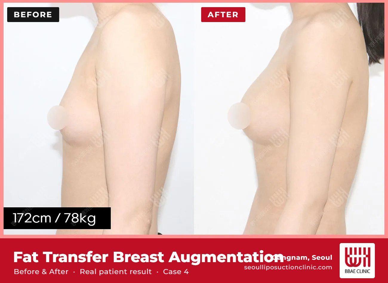 Fat transfer breast augmentation before and after, case 4 (photo 2 of 2) – BBAE Clinic, Gangnam Seoul