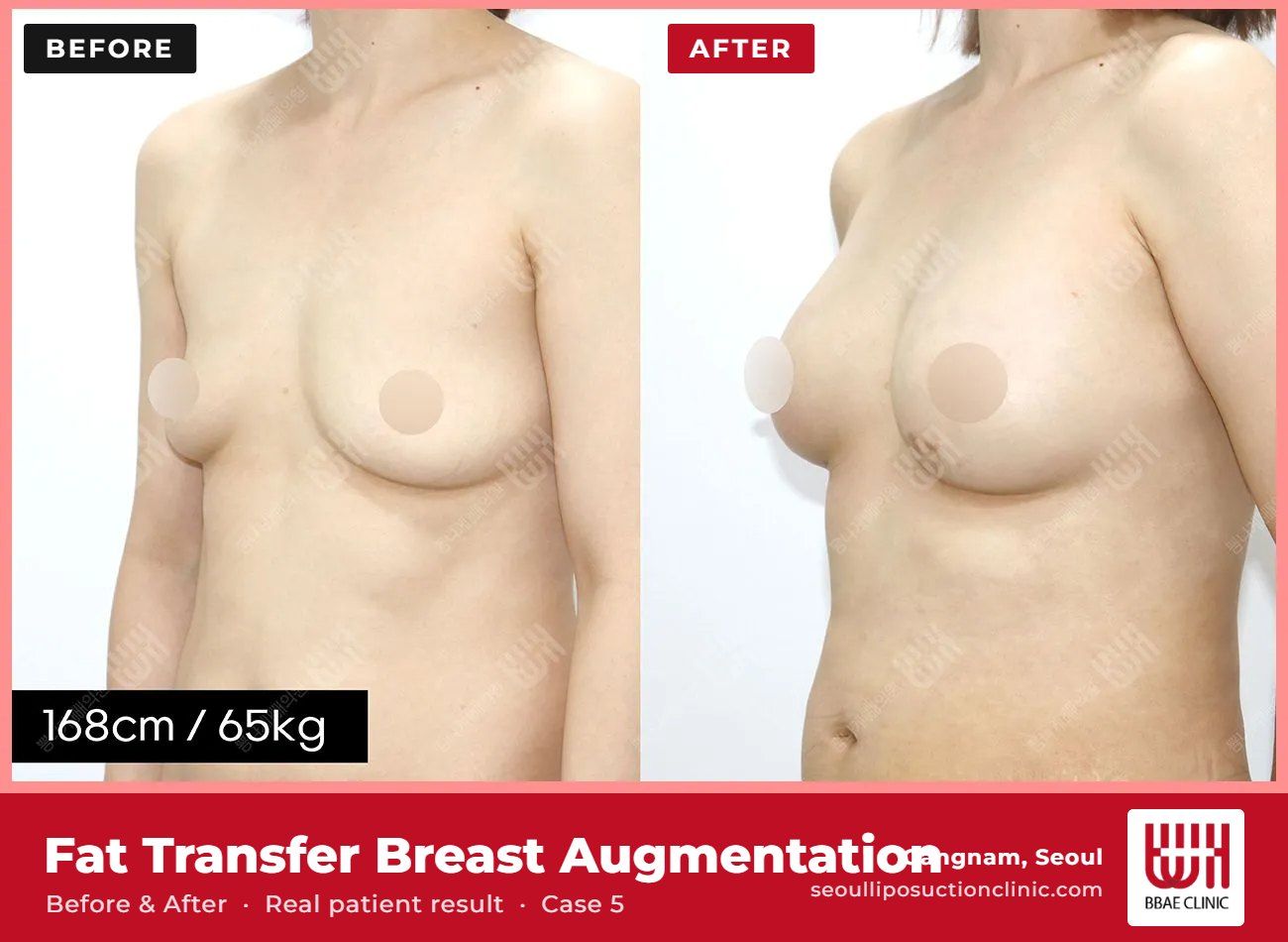 Fat transfer breast augmentation before and after, case 5 (photo 1 of 2) – BBAE Clinic, Gangnam Seoul