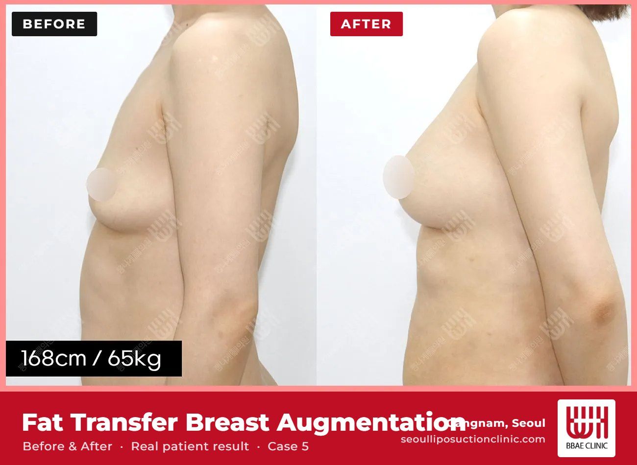 Fat transfer breast augmentation before and after, case 5 (photo 2 of 2) – BBAE Clinic, Gangnam Seoul
