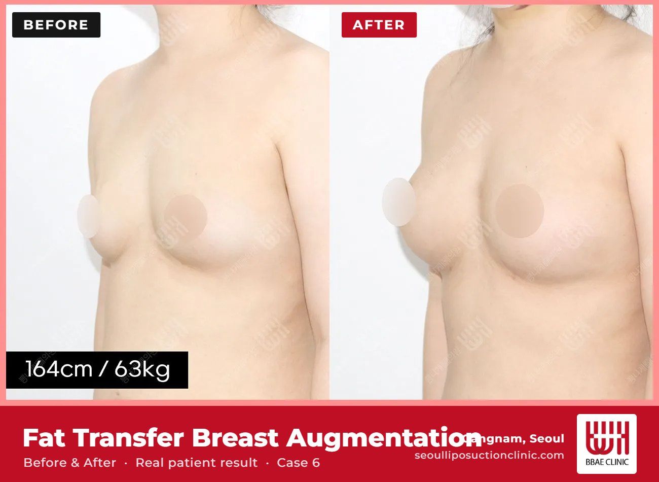 Fat transfer breast augmentation before and after, case 6 (photo 1 of 2) – BBAE Clinic, Gangnam Seoul