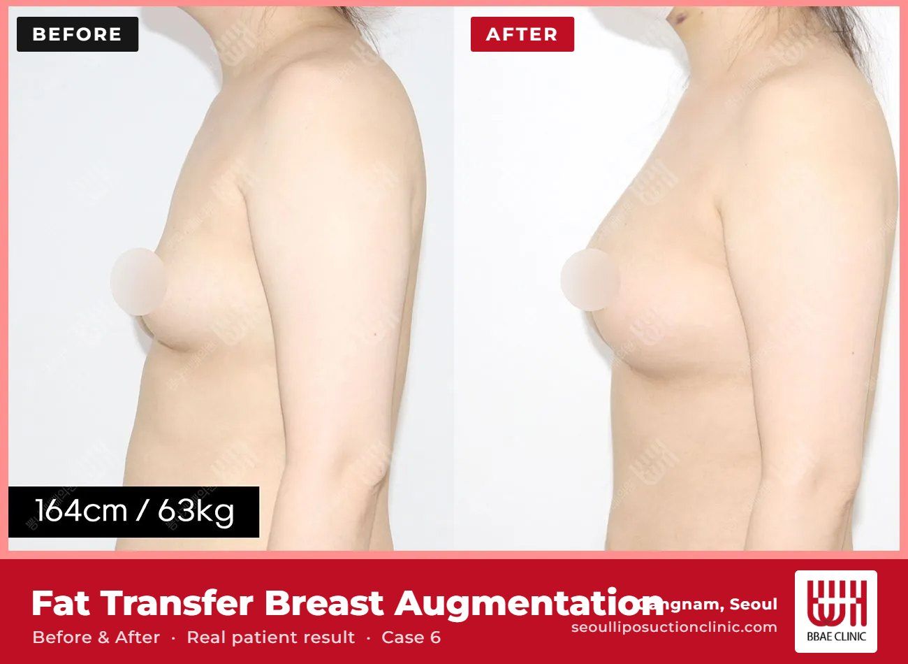 Fat transfer breast augmentation before and after, case 6 (photo 2 of 2) – BBAE Clinic, Gangnam Seoul
