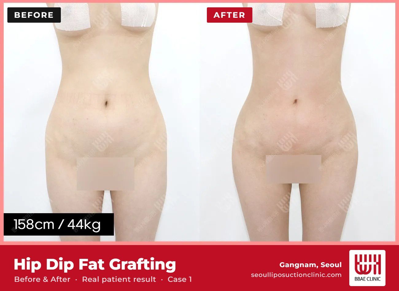 Hip dip fat grafting before and after, case 1 (photo 1 of 2) – BBAE Clinic, Gangnam Seoul
