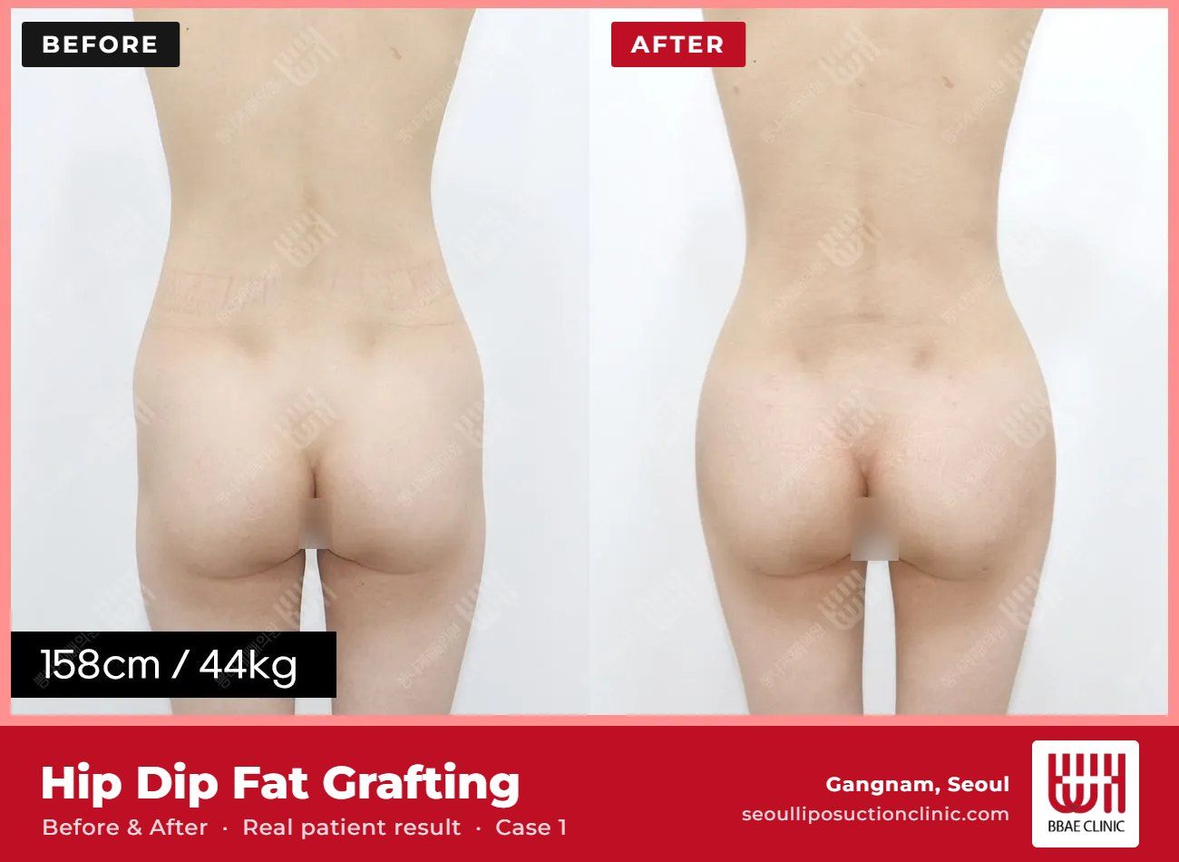 Hip dip fat grafting before and after, case 1 (photo 2 of 2) – BBAE Clinic, Gangnam Seoul