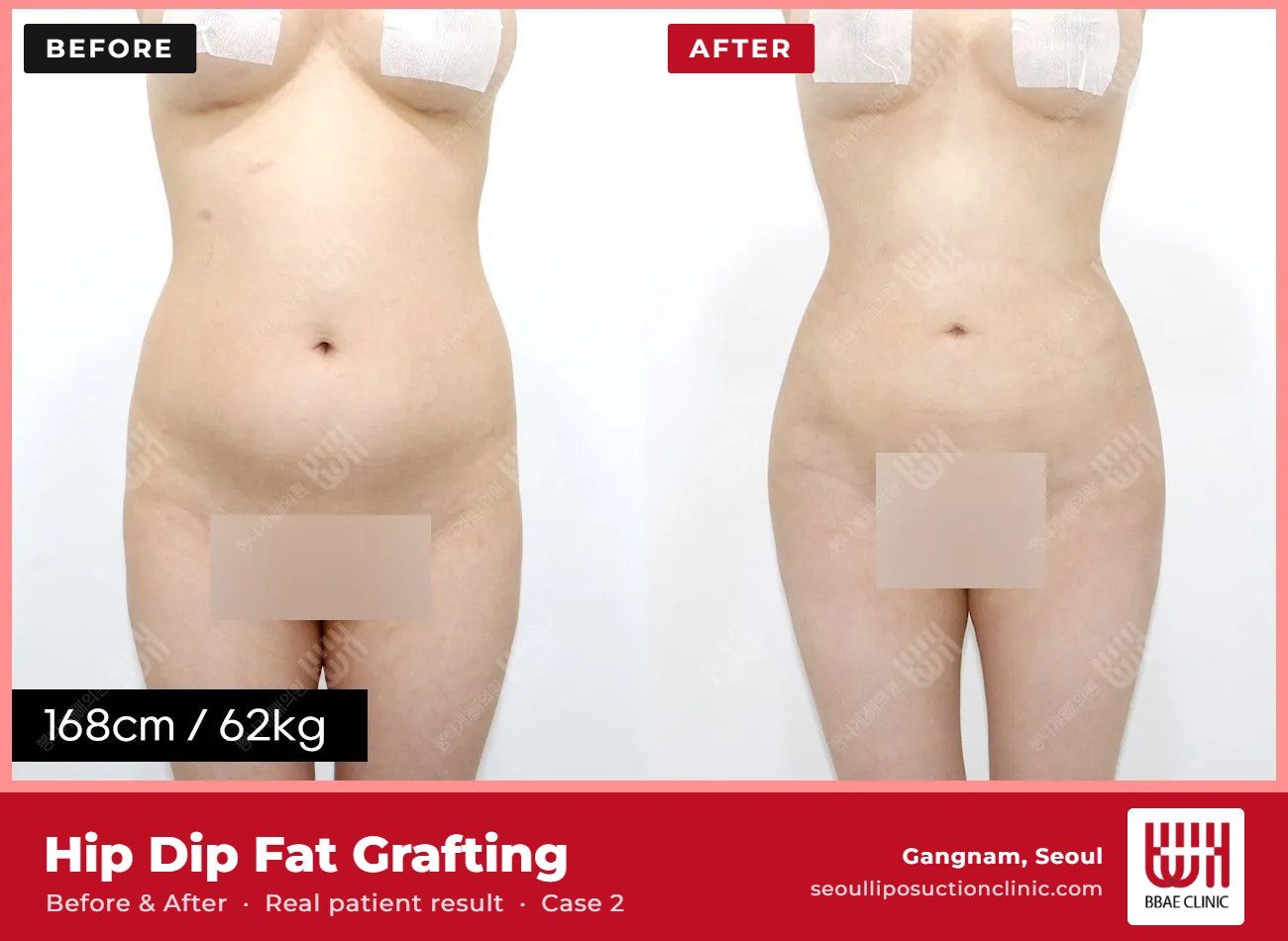 Hip dip fat grafting before and after, case 2 (photo 1 of 2) – BBAE Clinic, Gangnam Seoul