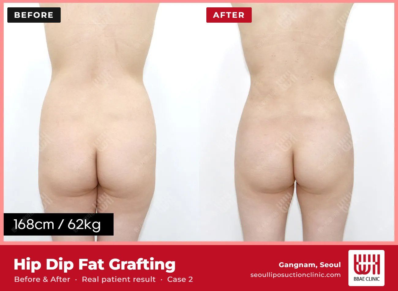 Hip dip fat grafting before and after, case 2 (photo 2 of 2) – BBAE Clinic, Gangnam Seoul