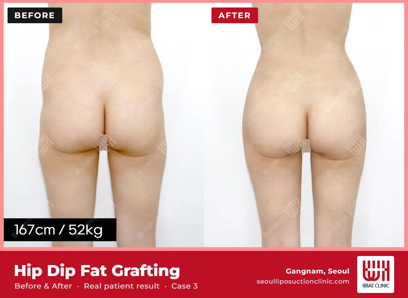 Hip dip fat grafting before and after, case 3 (photo 1 of 2) – BBAE Clinic, Gangnam Seoul