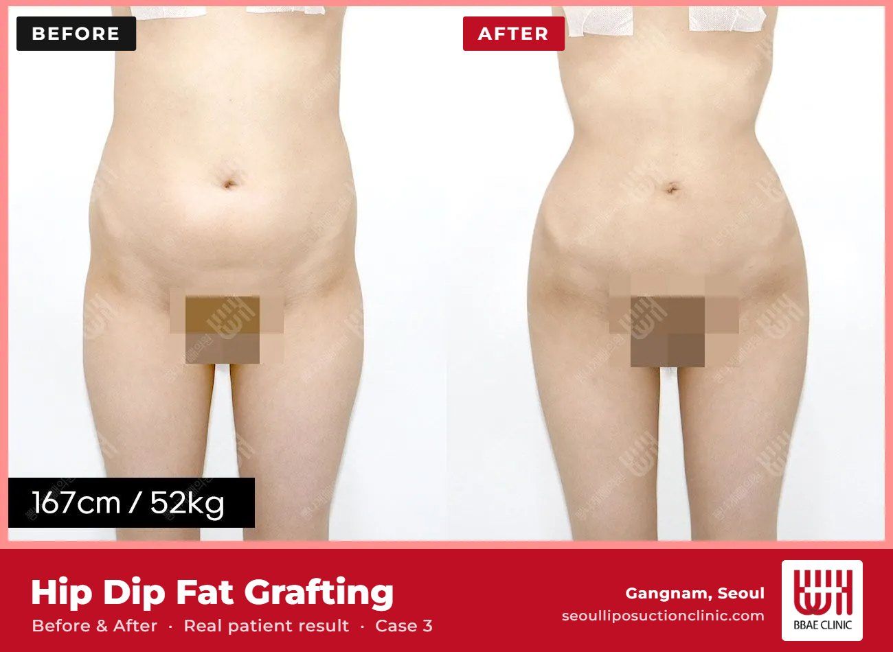 Hip dip fat grafting before and after, case 3 (photo 2 of 2) – BBAE Clinic, Gangnam Seoul