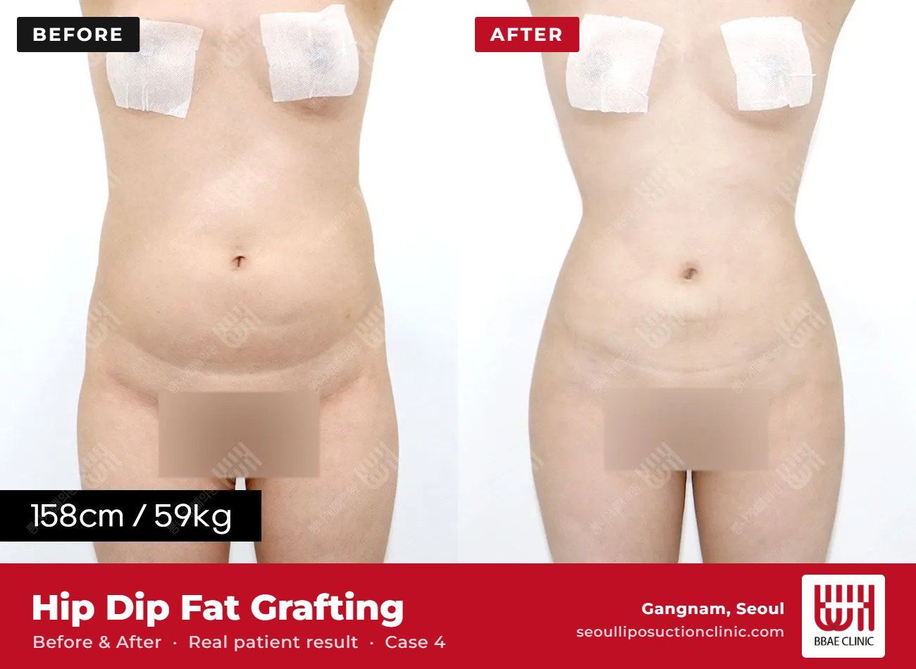 Hip dip fat grafting before and after, case 4 (photo 2 of 2) – BBAE Clinic, Gangnam Seoul