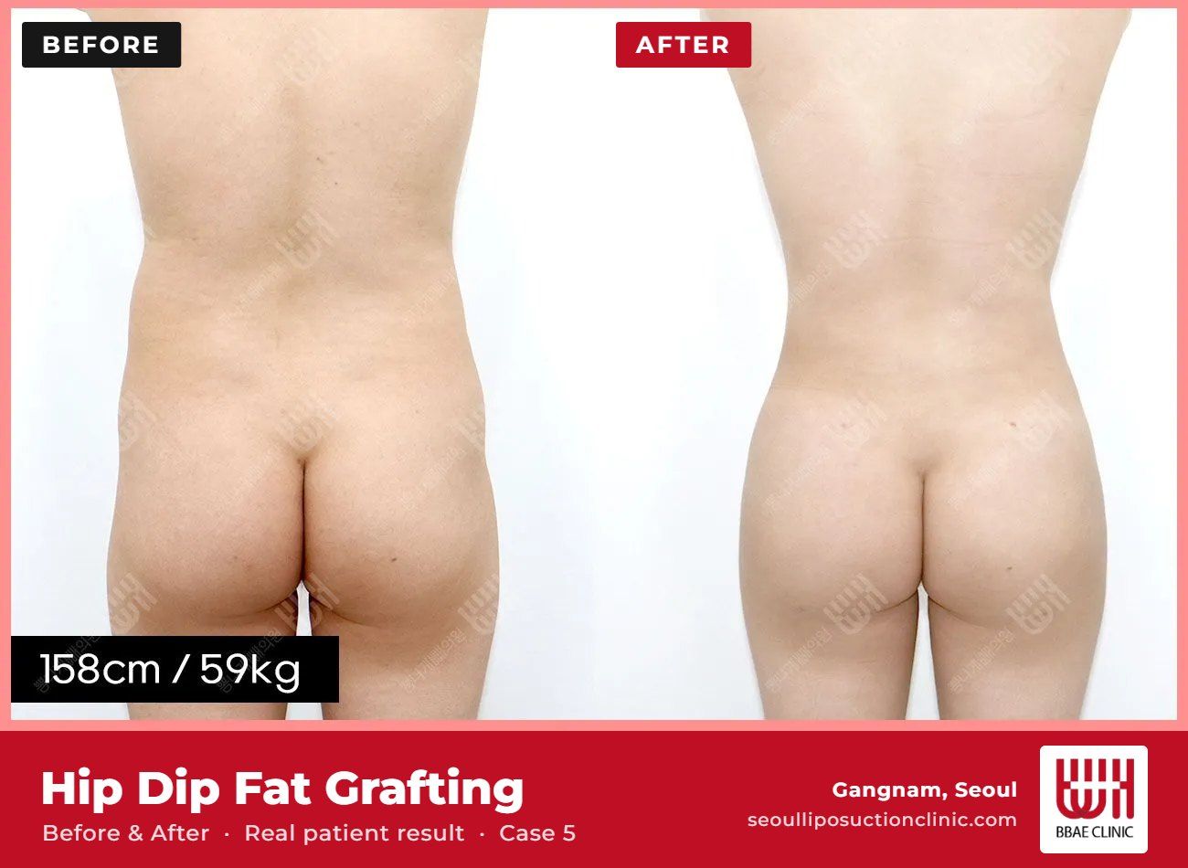 Hip dip fat grafting before and after, case 5 (photo 1 of 2) – BBAE Clinic, Gangnam Seoul
