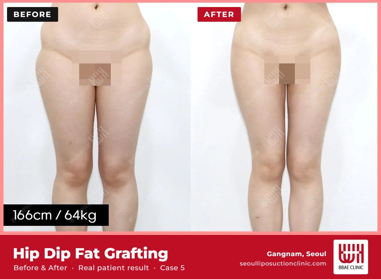 Hip dip fat grafting before and after, case 5 (photo 2 of 2) – BBAE Clinic, Gangnam Seoul