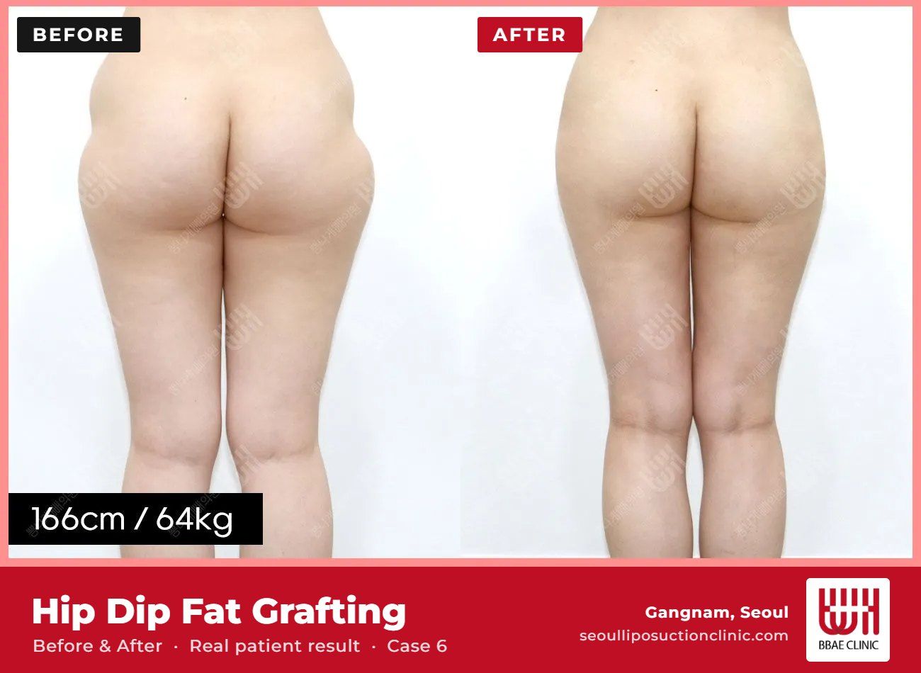 Hip dip fat grafting before and after, case 6 (photo 1 of 2) – BBAE Clinic, Gangnam Seoul