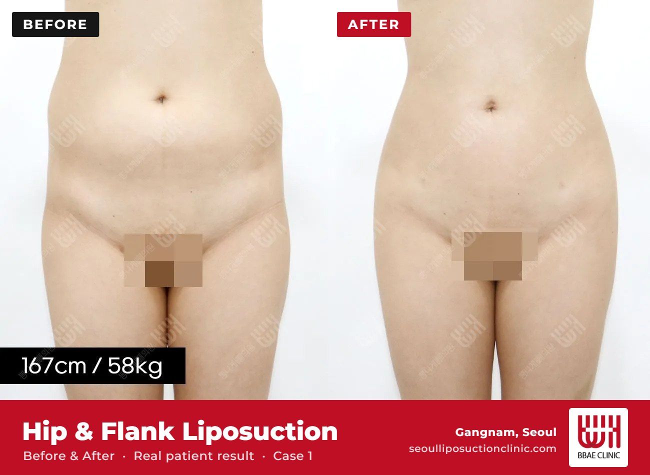 Hip and flank liposuction before and after, case 1 (photo 1 of 2) – BBAE Clinic, Gangnam Seoul