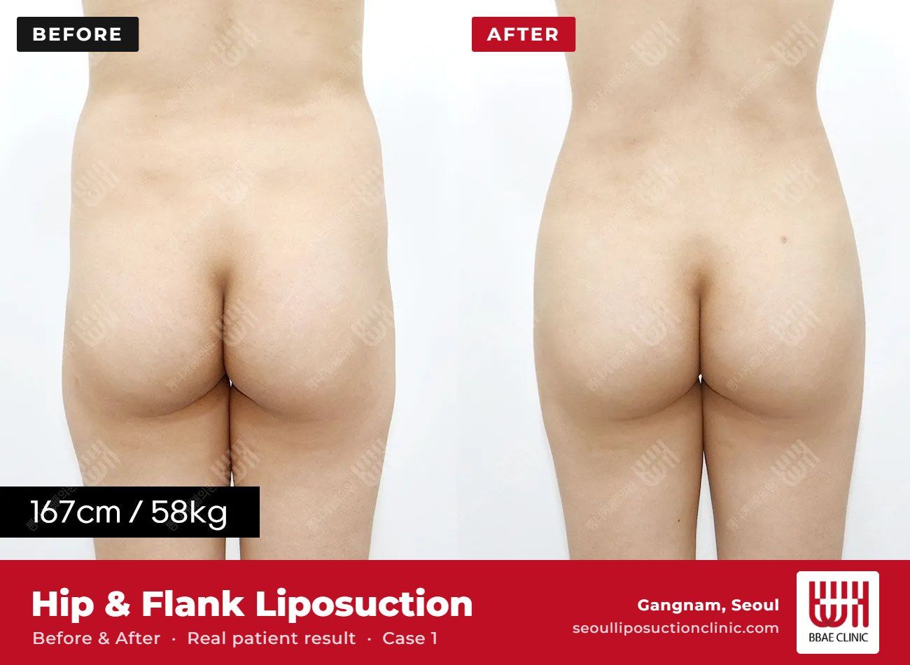 Hip and flank liposuction before and after, case 1 (photo 2 of 2) – BBAE Clinic, Gangnam Seoul