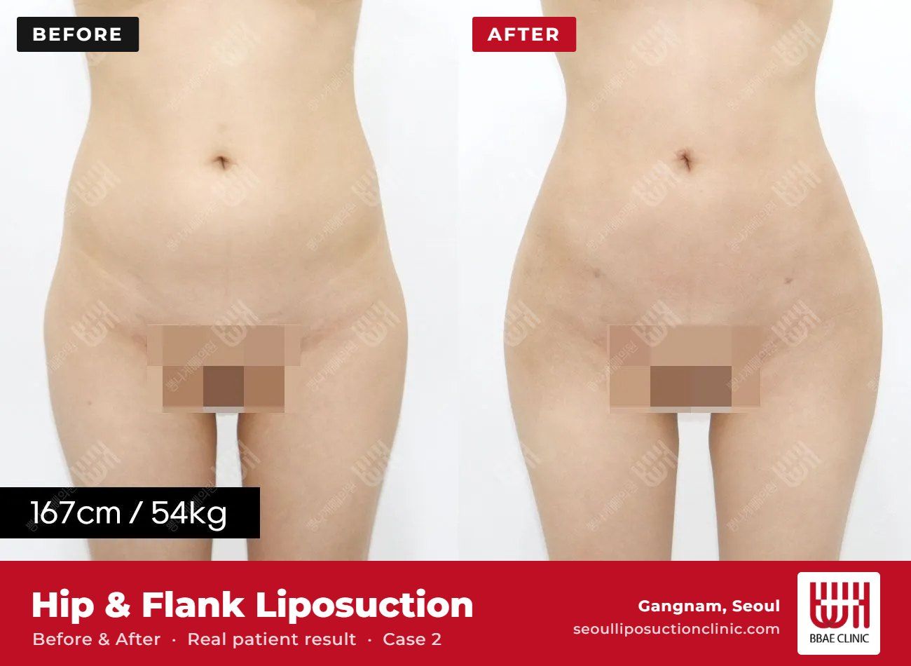 Hip and flank liposuction before and after, case 2 (photo 1 of 2) – BBAE Clinic, Gangnam Seoul