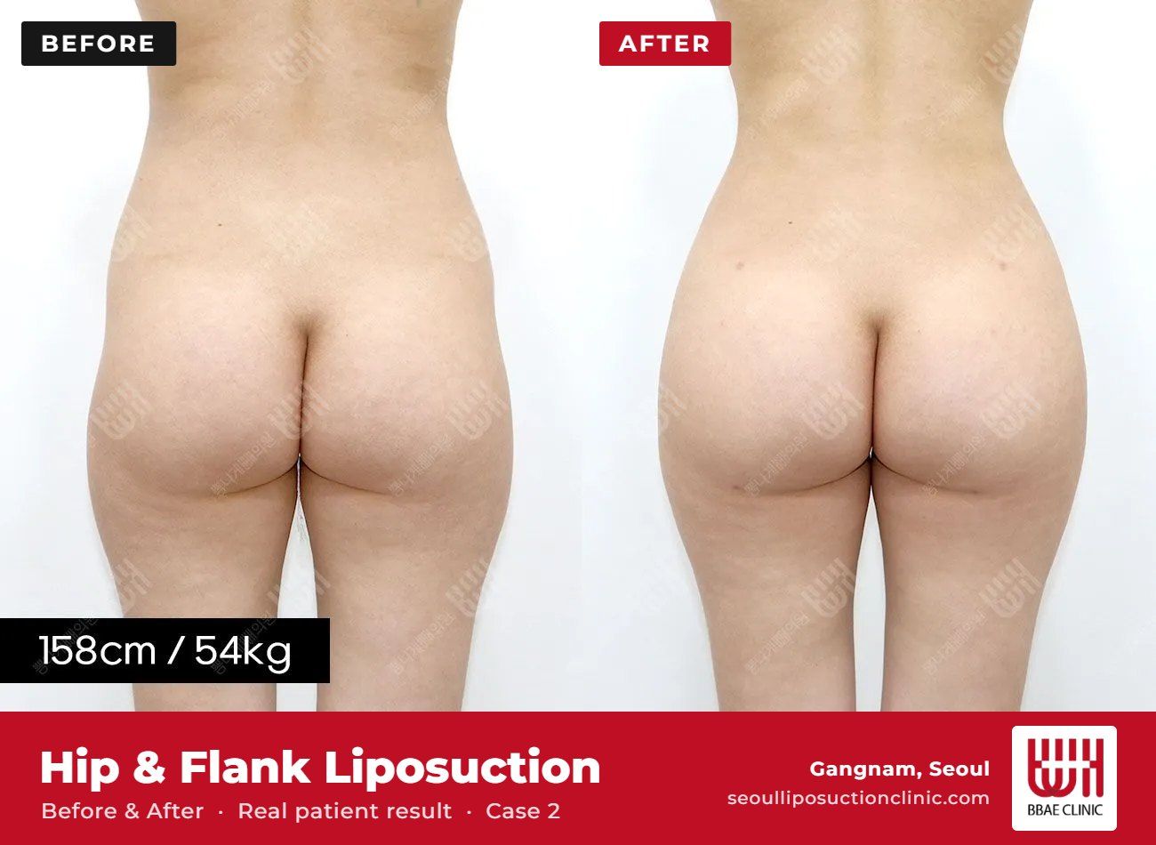 Hip and flank liposuction before and after, case 2 (photo 2 of 2) – BBAE Clinic, Gangnam Seoul