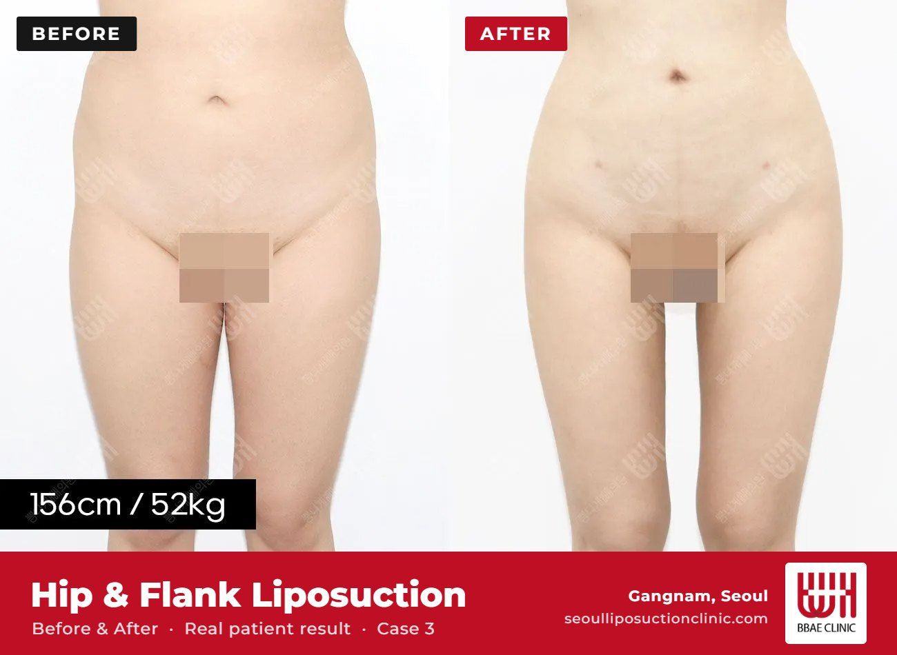 Hip and flank liposuction before and after, case 3 (photo 1 of 2) – BBAE Clinic, Gangnam Seoul