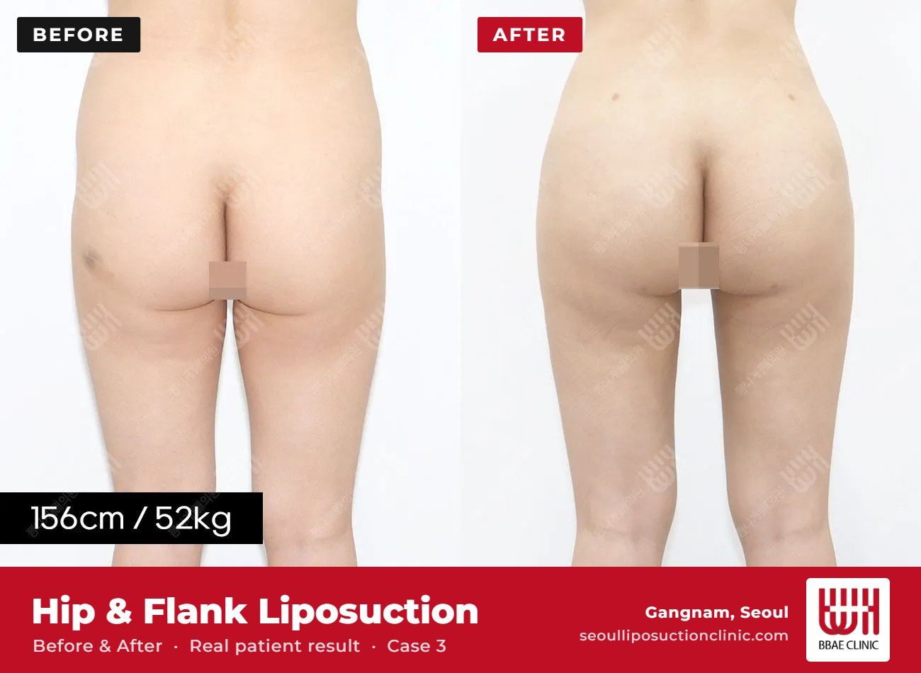 Hip and flank liposuction before and after, case 3 (photo 2 of 2) – BBAE Clinic, Gangnam Seoul