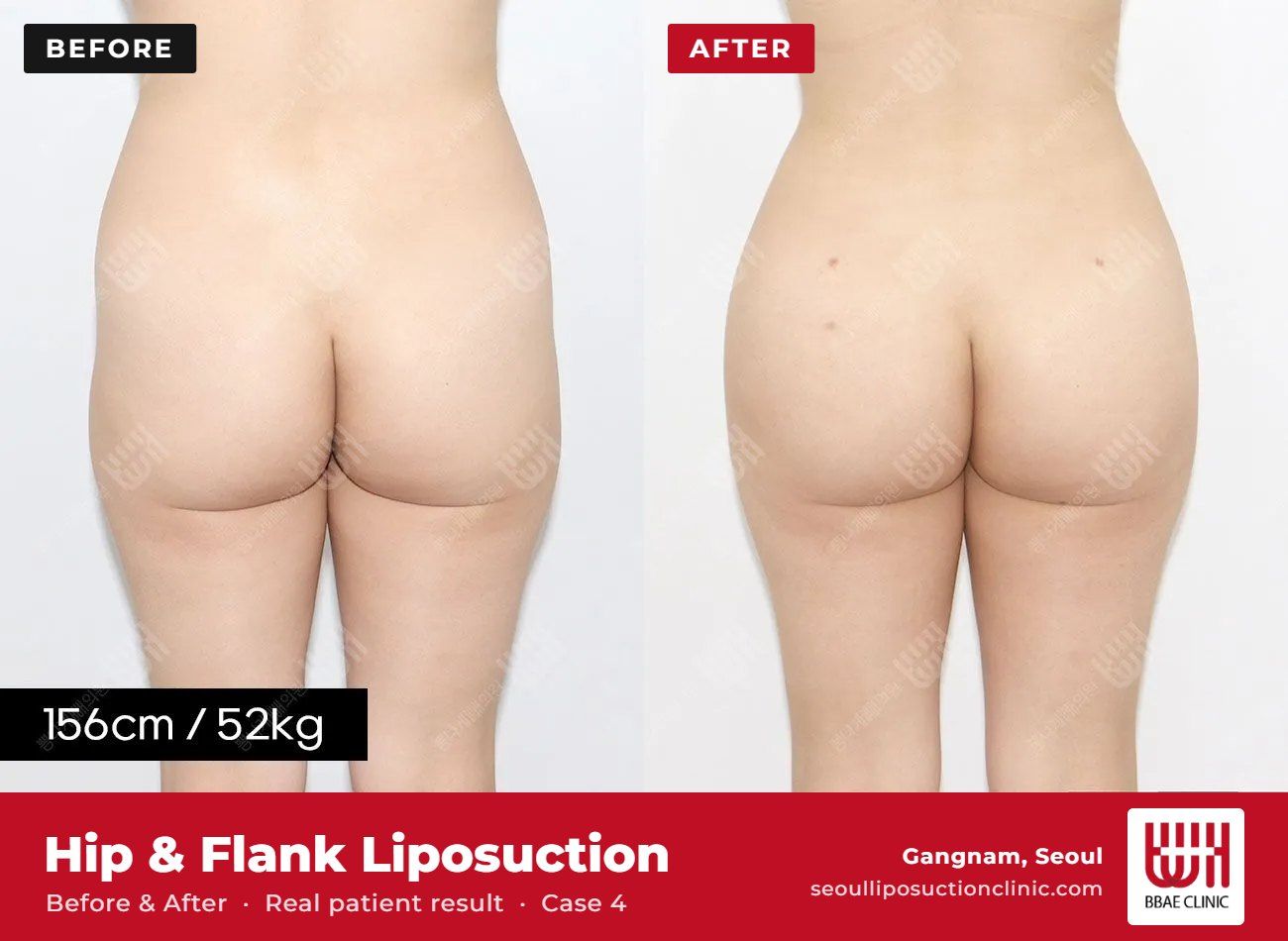 Hip and flank liposuction before and after, case 4 (photo 1 of 2) – BBAE Clinic, Gangnam Seoul