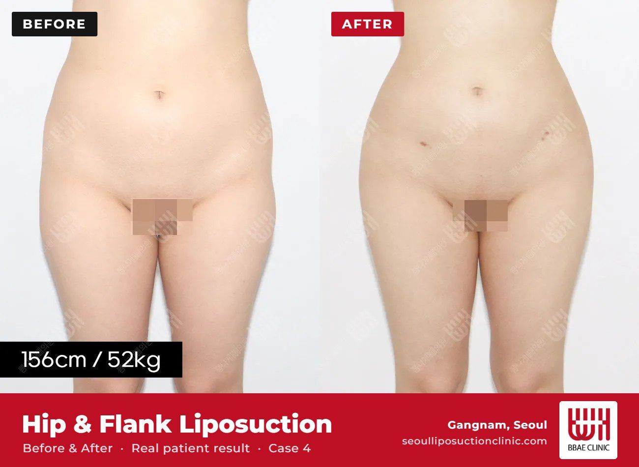 Hip and flank liposuction before and after, case 4 (photo 2 of 2) – BBAE Clinic, Gangnam Seoul