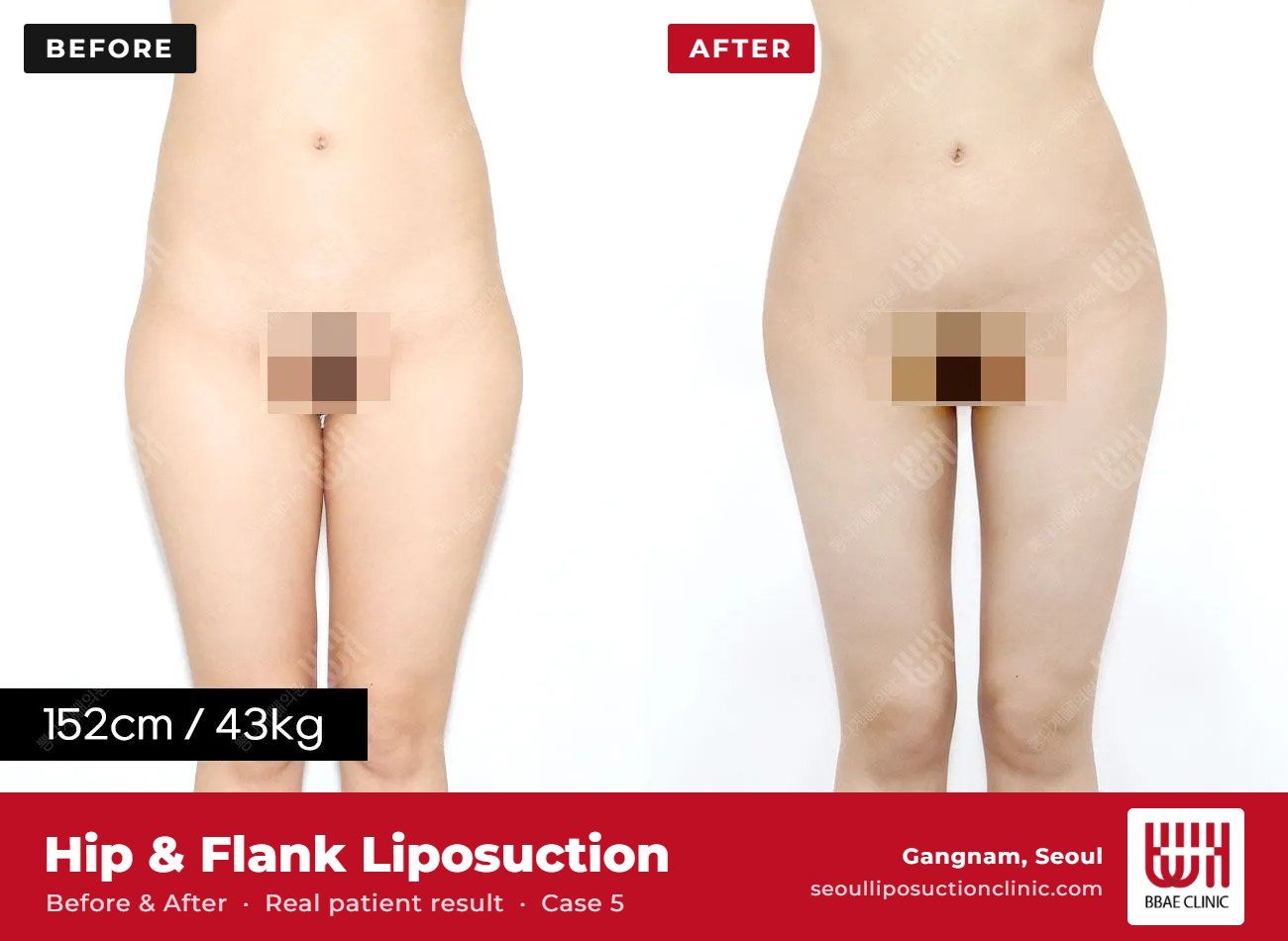 Hip and flank liposuction before and after, case 5 (photo 1 of 2) – BBAE Clinic, Gangnam Seoul