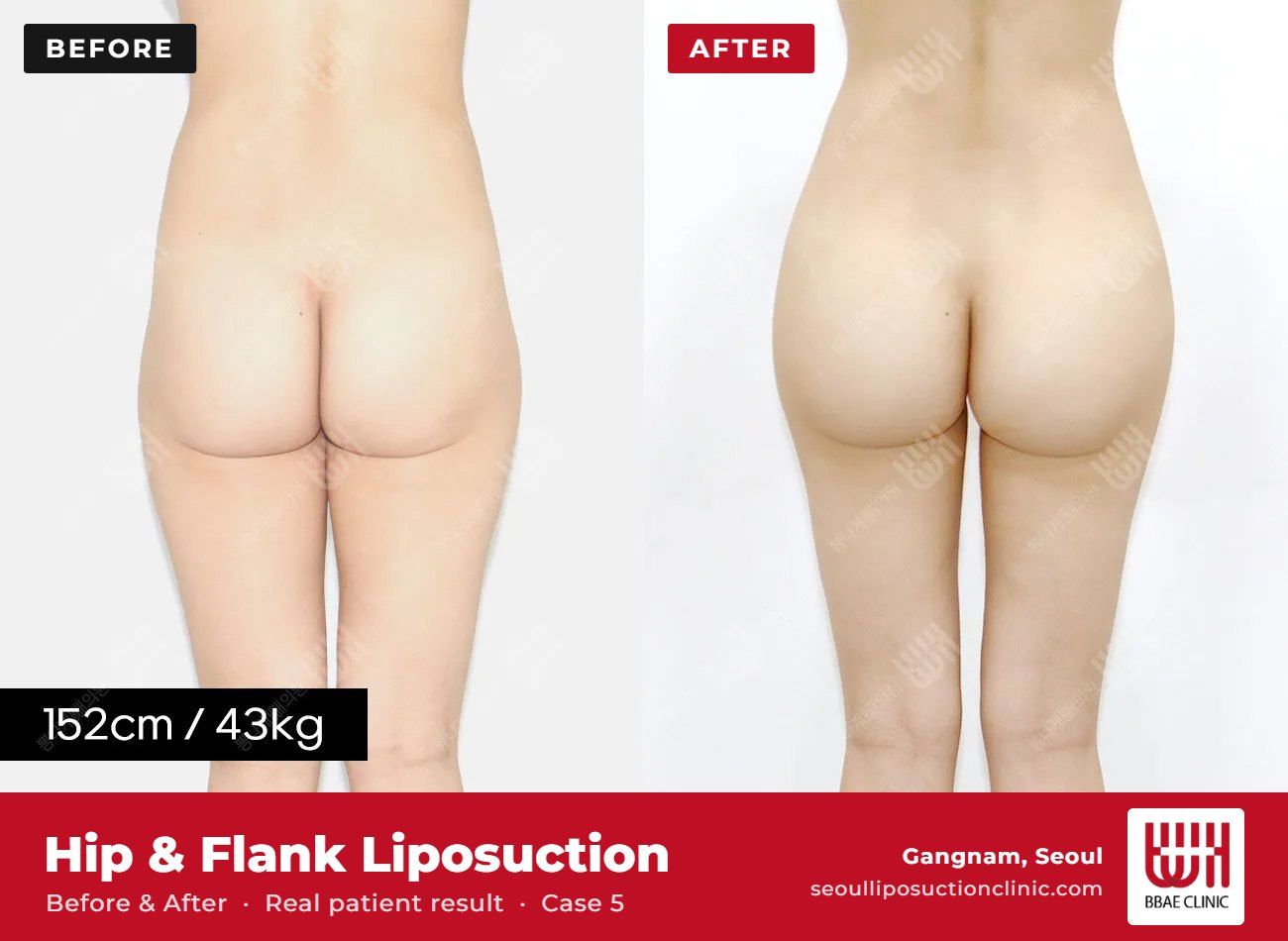 Hip and flank liposuction before and after, case 5 (photo 2 of 2) – BBAE Clinic, Gangnam Seoul