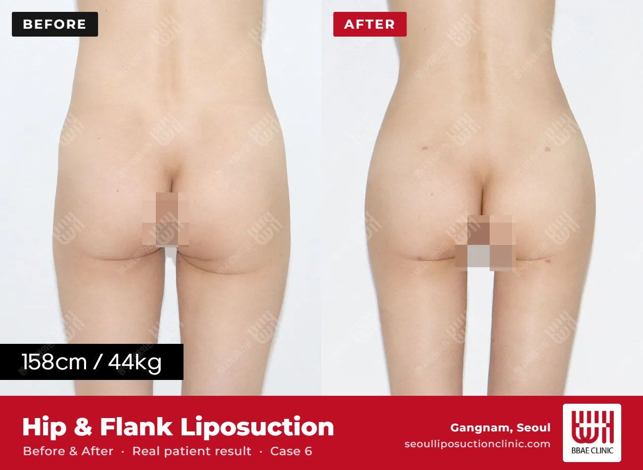 Hip and flank liposuction before and after, case 6 (photo 1 of 2) – BBAE Clinic, Gangnam Seoul