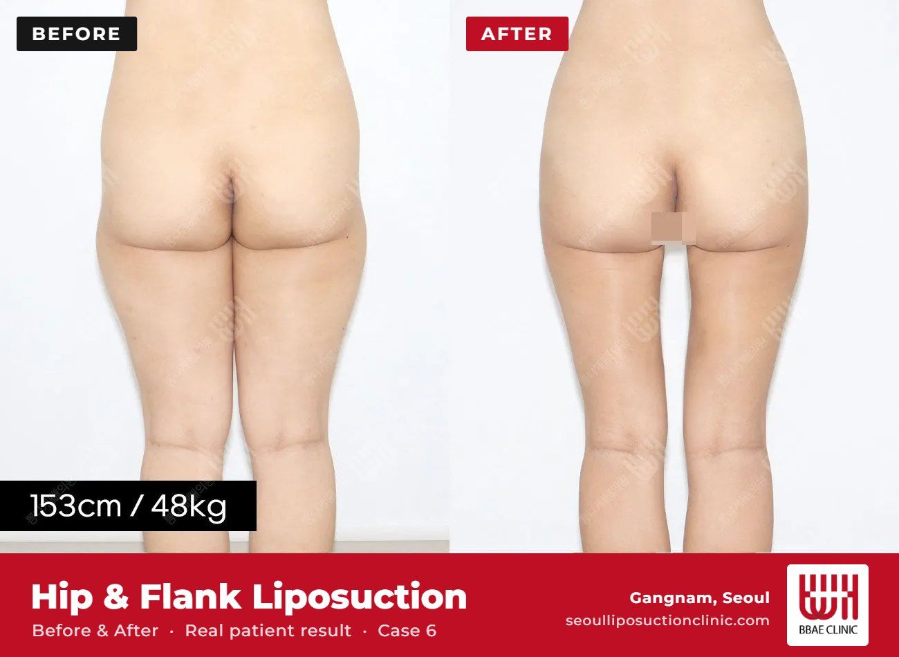 Hip and flank liposuction before and after, case 6 (photo 2 of 2) – BBAE Clinic, Gangnam Seoul