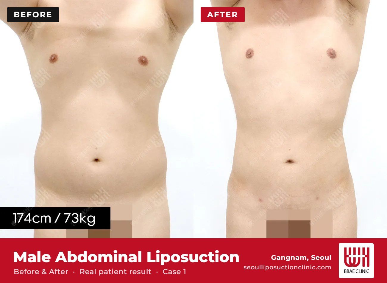 Male abdominal liposuction before and after, case 1 (photo 1 of 2) – BBAE Clinic, Gangnam Seoul