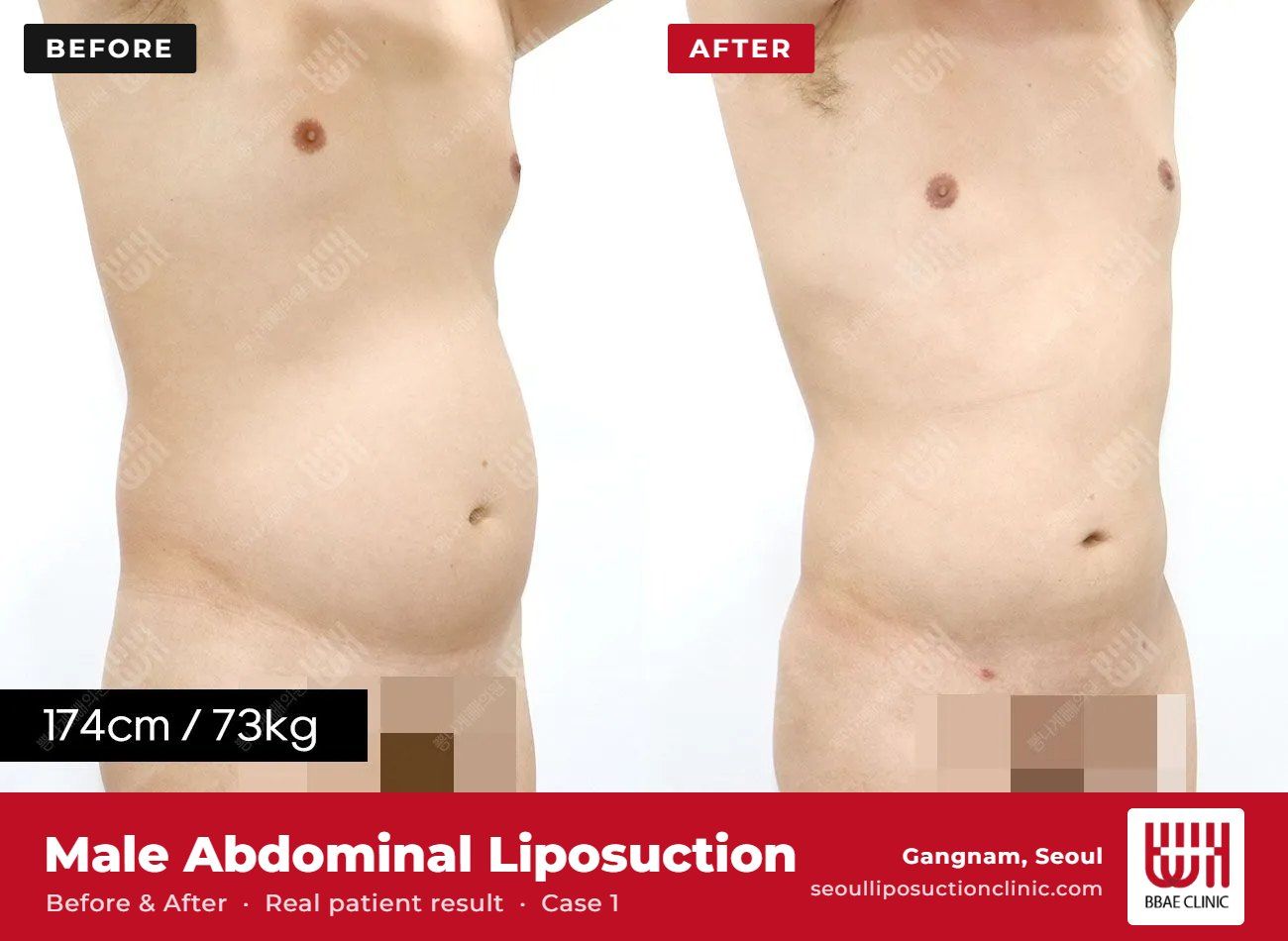 Male abdominal liposuction before and after, case 1 (photo 2 of 2) – BBAE Clinic, Gangnam Seoul