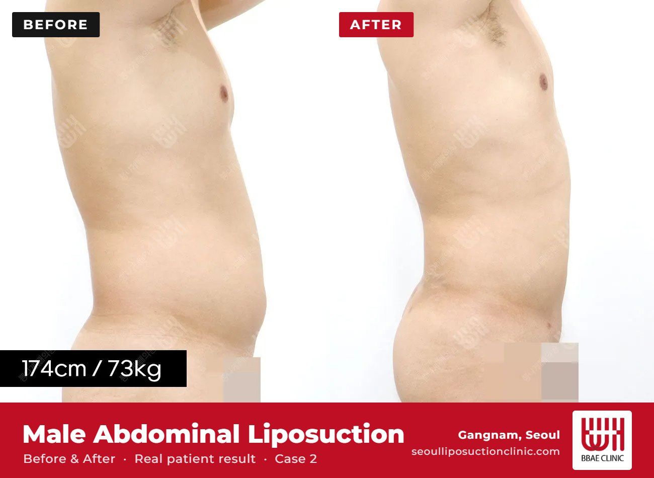 Male abdominal liposuction before and after, case 2 (photo 1 of 2) – BBAE Clinic, Gangnam Seoul
